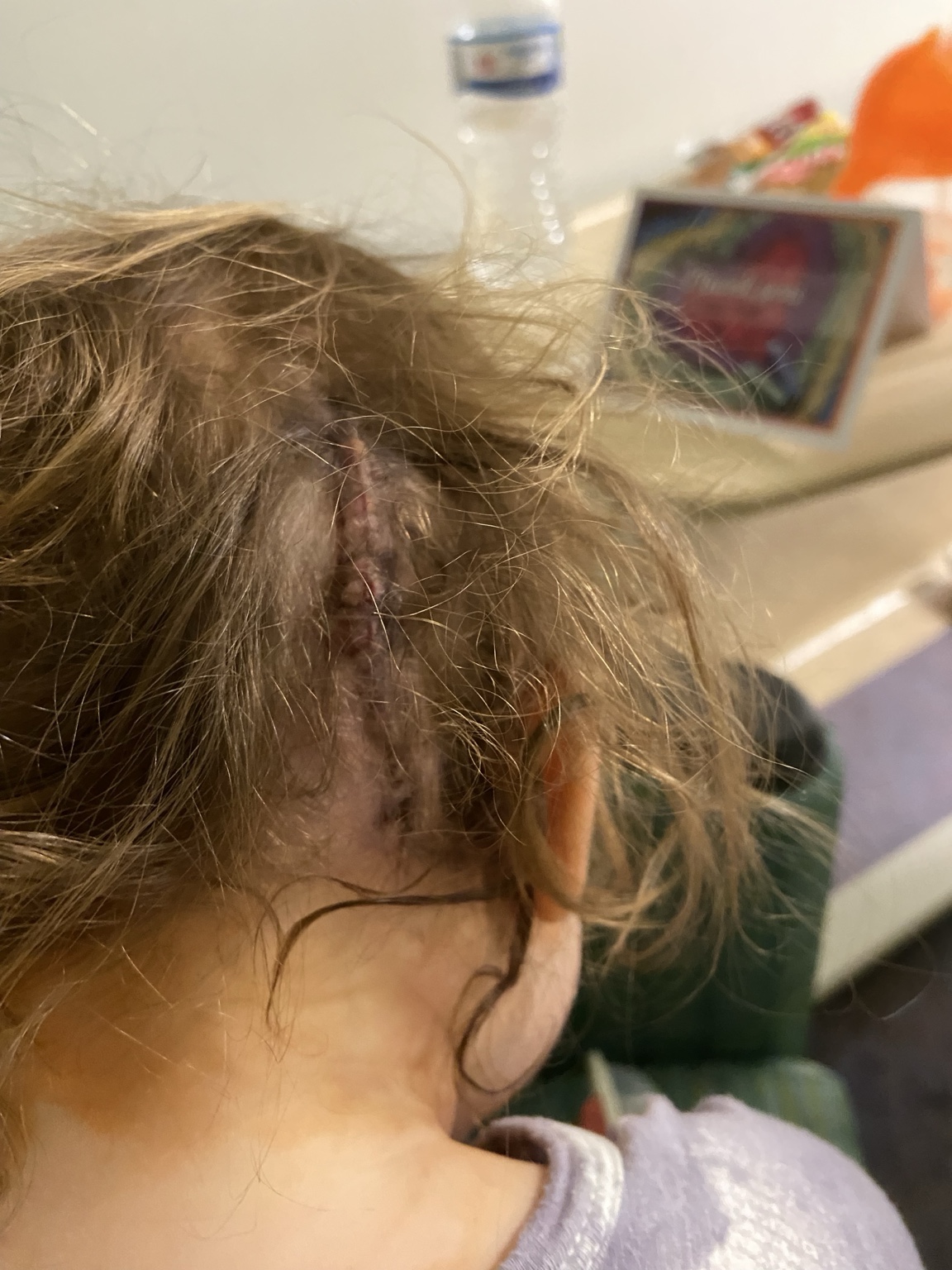 Lizzie's healing surgical scar